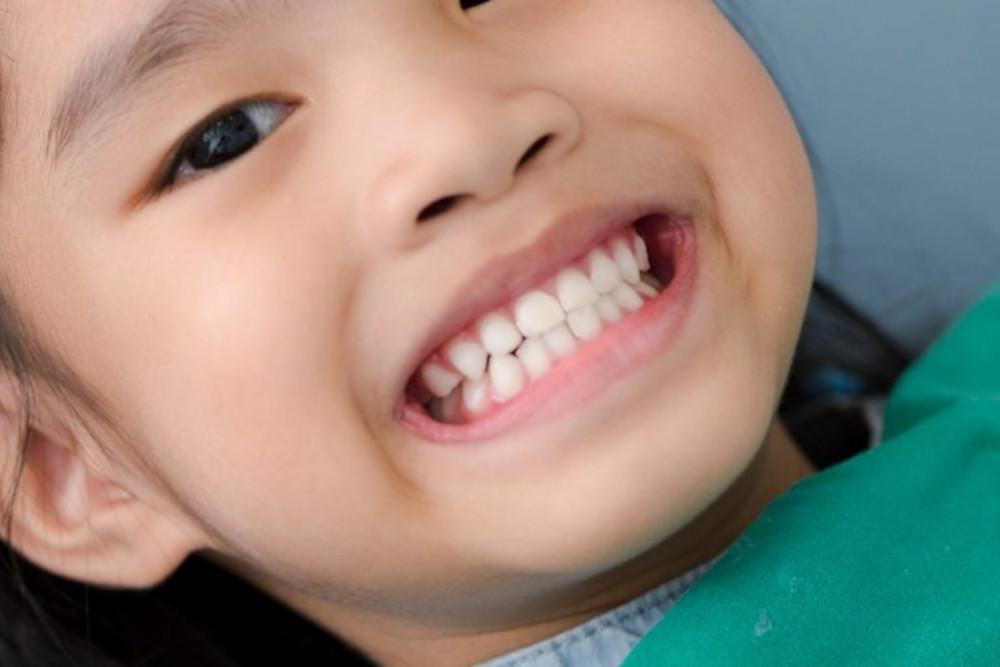 Manfaat dan Efek Samping Fluoride Varnish untuk Mencegah Kerusakan Gigi