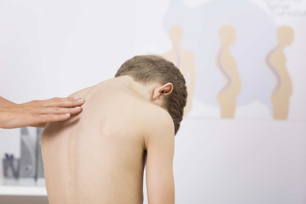 gejala ciri ciri skoliosis pada anak