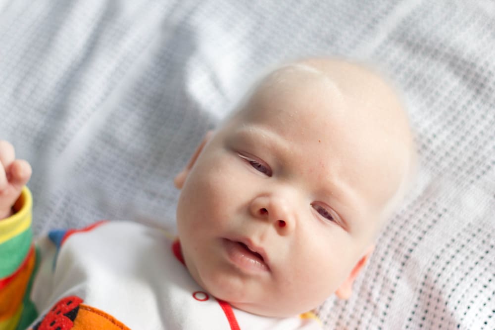 Albinisme, Kondisi Genetik yang Membuat Kulit Lebih Pucat