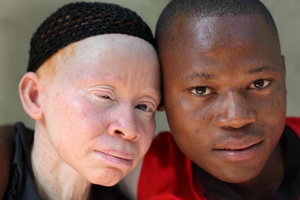 8 Fakta tentang Albino yang Perlu Anda Ketahui