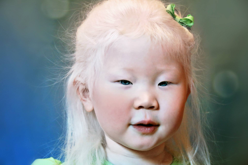 fakta tentang anak albino