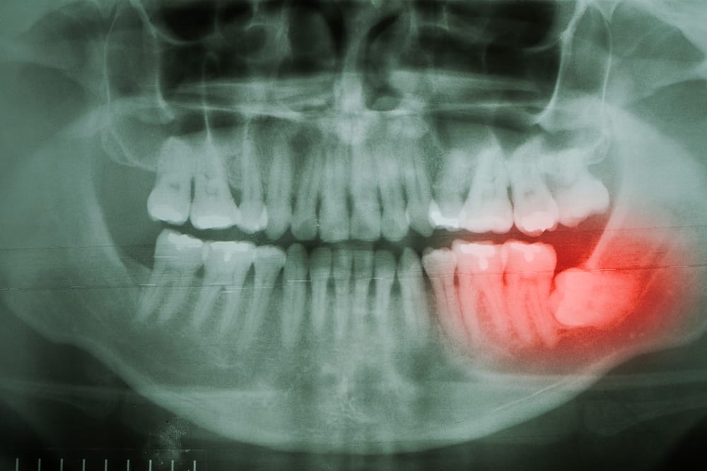 Kenapa Tumbuh Gigi Bungsu Bisa Terasa Sangat Menyakitkan?