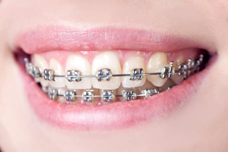 Bagaimana Proses Pemasangan Behel atau Kawat Gigi?