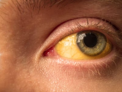 Penyakit kuning gejala hepatitis C