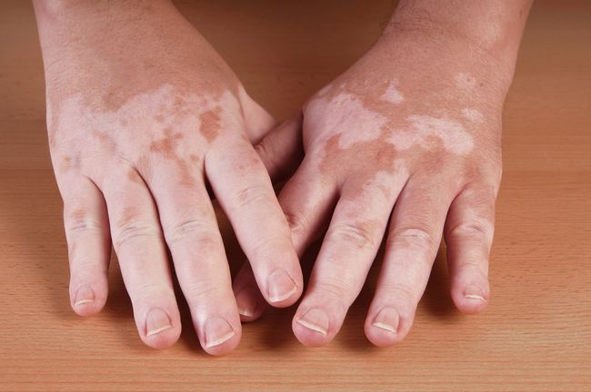 vitiligo bisa sembuh