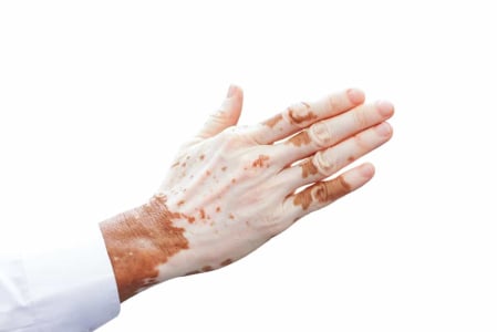 Mengapa Gejala Penyakit Kulit Vitiligo Baru Muncul Saat Dewasa?
