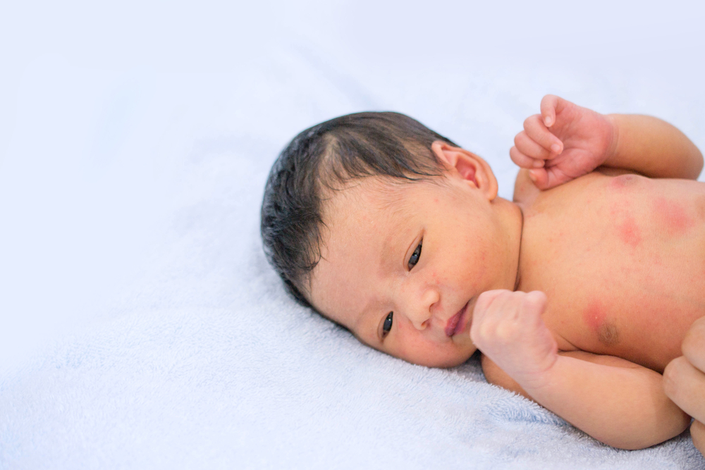 Bentol Merah pada Bayi: Penyebab dan Cara Mengatasinya