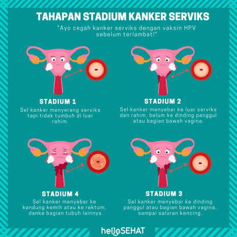 Kanker Serviks Stadium 1, Ini Yang Terjadi Pada Tubuh Anda