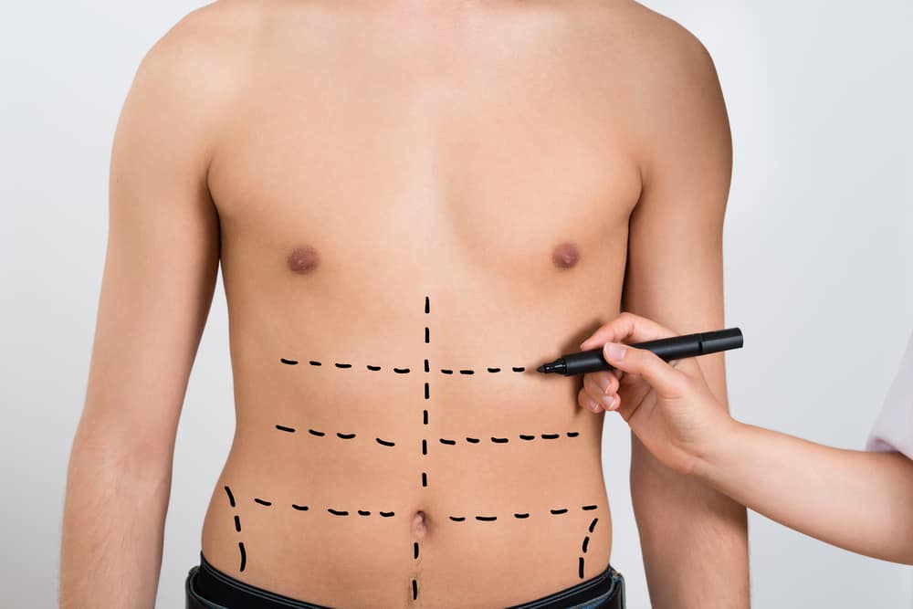 Abdominal Etching, Prosedur Baru yang Jadi Solusi Perut Buncit Pada Pria