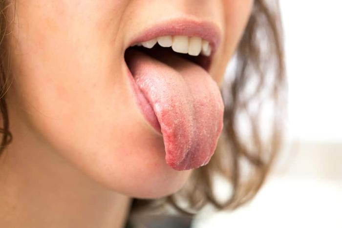 penyebab lidah gatal