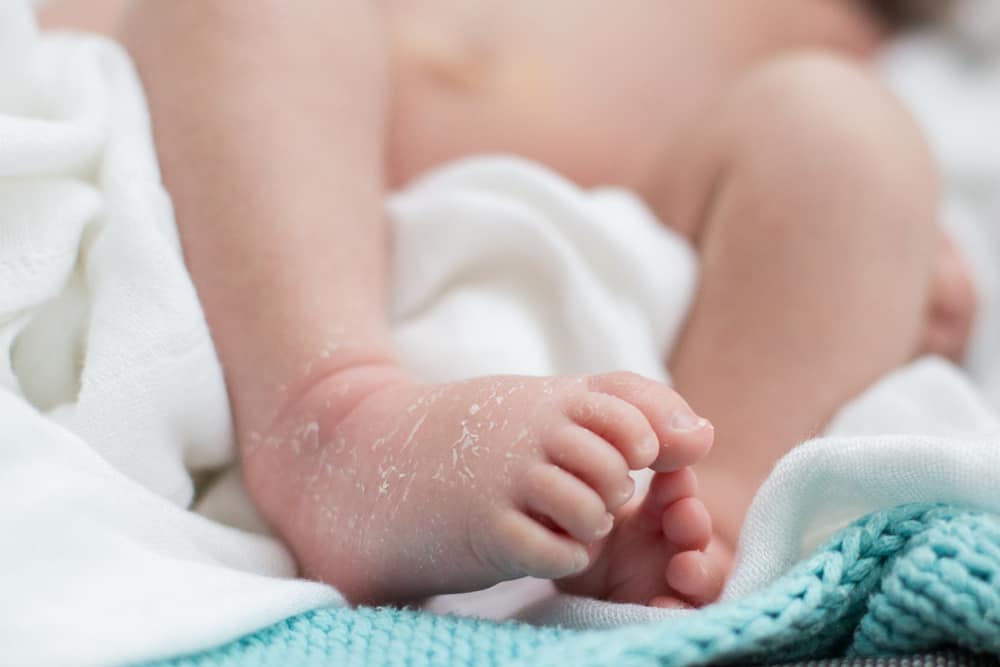 Kulit Bayi Kering Sampai Mengelupas? Ini Penyebab, Cara Mencegah dan Mengatasinya