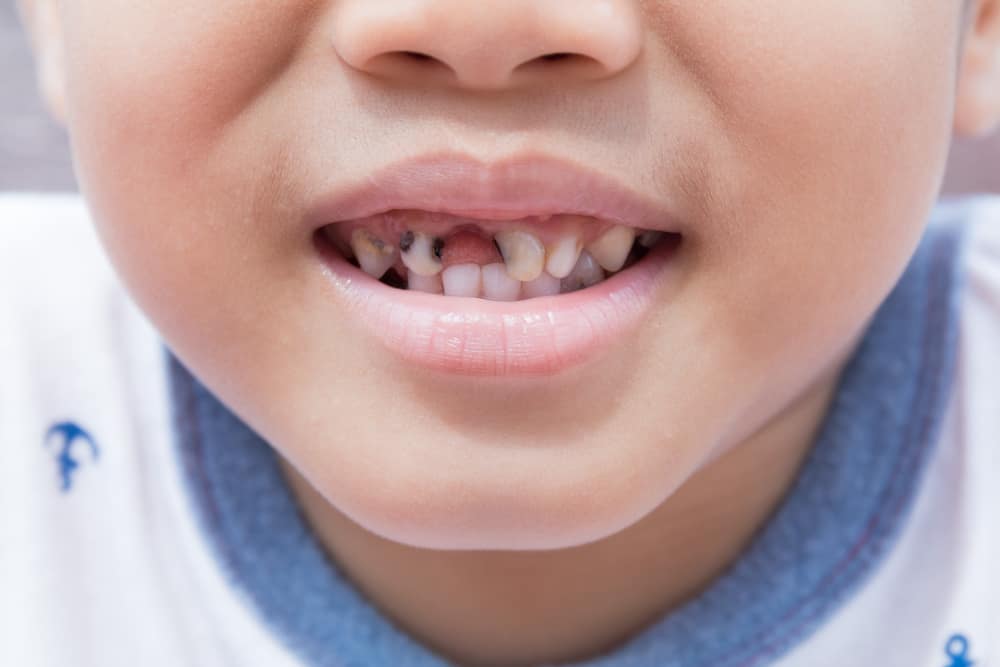 6 Hal Ini Bisa Sebabkan Gigi Anak Berwarna Hitam, Bagaimana Cara Mencegahnya?