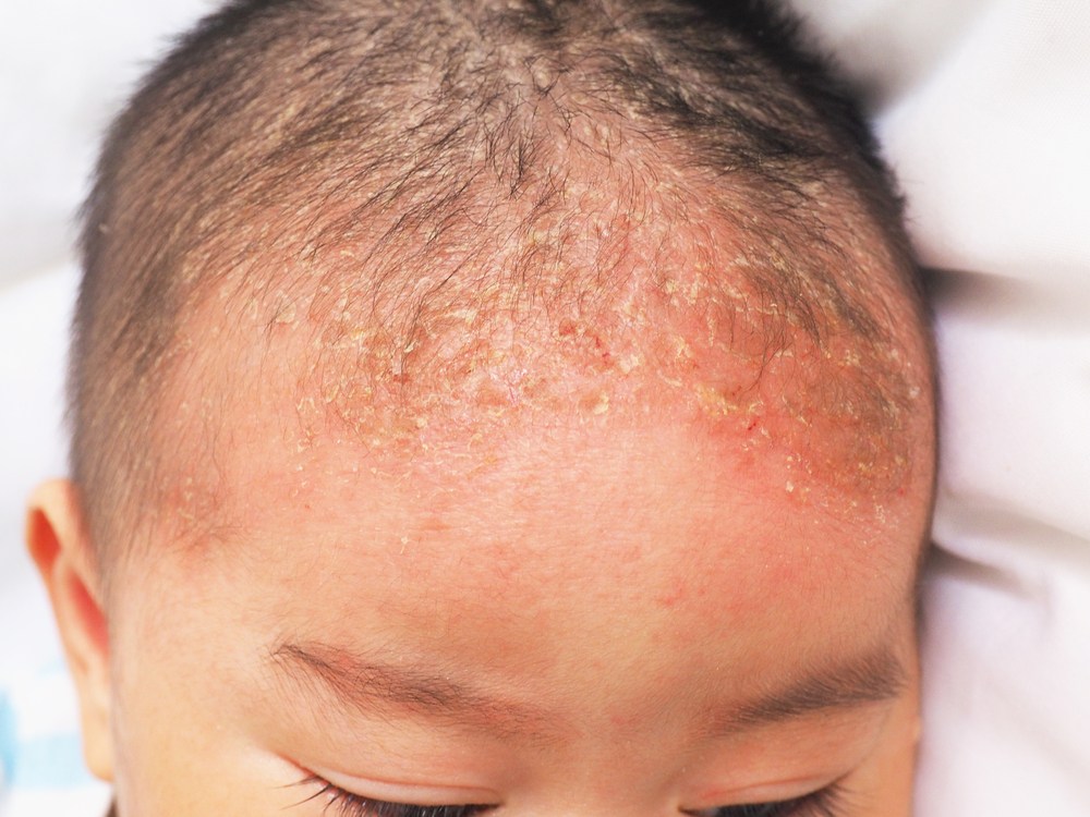 Serba-serbi Cradle Cap (Dermatitis Seboroik) pada Bayi