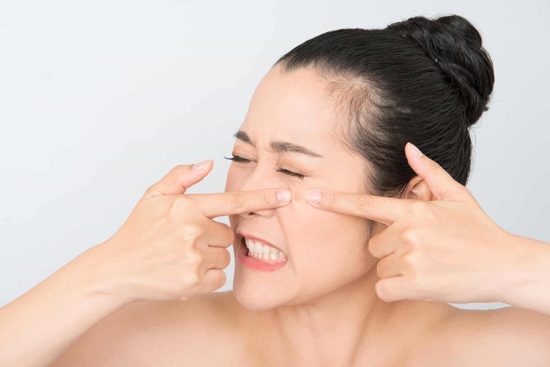 Apakah Terapi IPL (Intense Pulsed Light) Ampuh untuk Menghilangkan Jerawat?