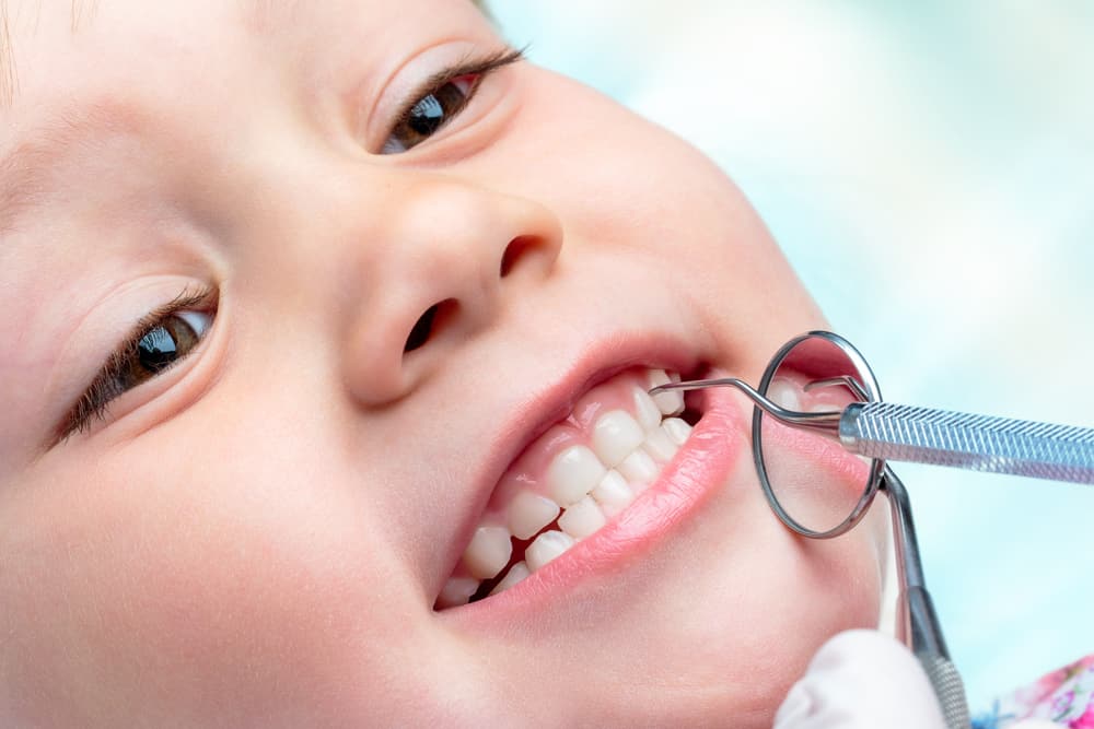 Cara Jitu Menghilangkan Karang Gigi pada Anak