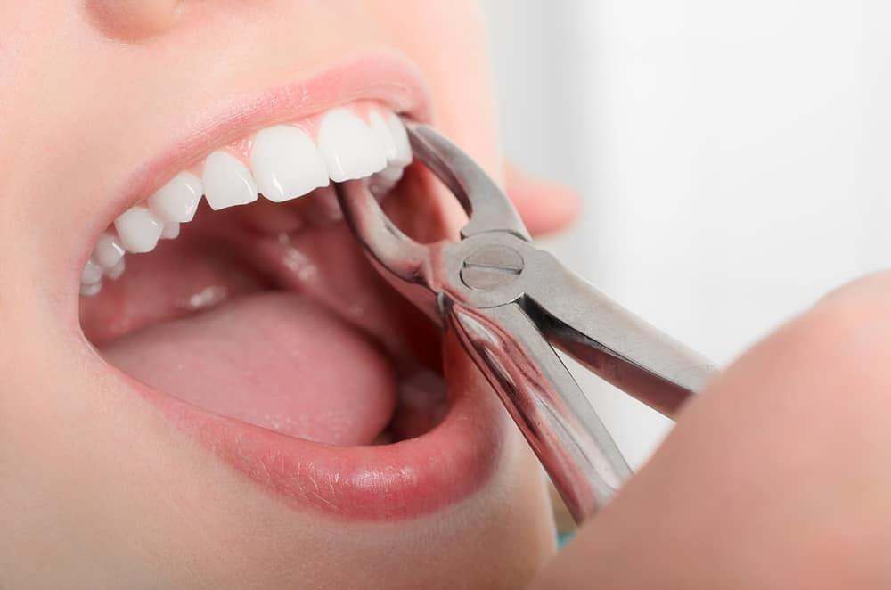 cabut gigi merupakan salah satu cara mengatasi gigi berlubang berdarah dan bernanah