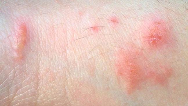 Dermatitis