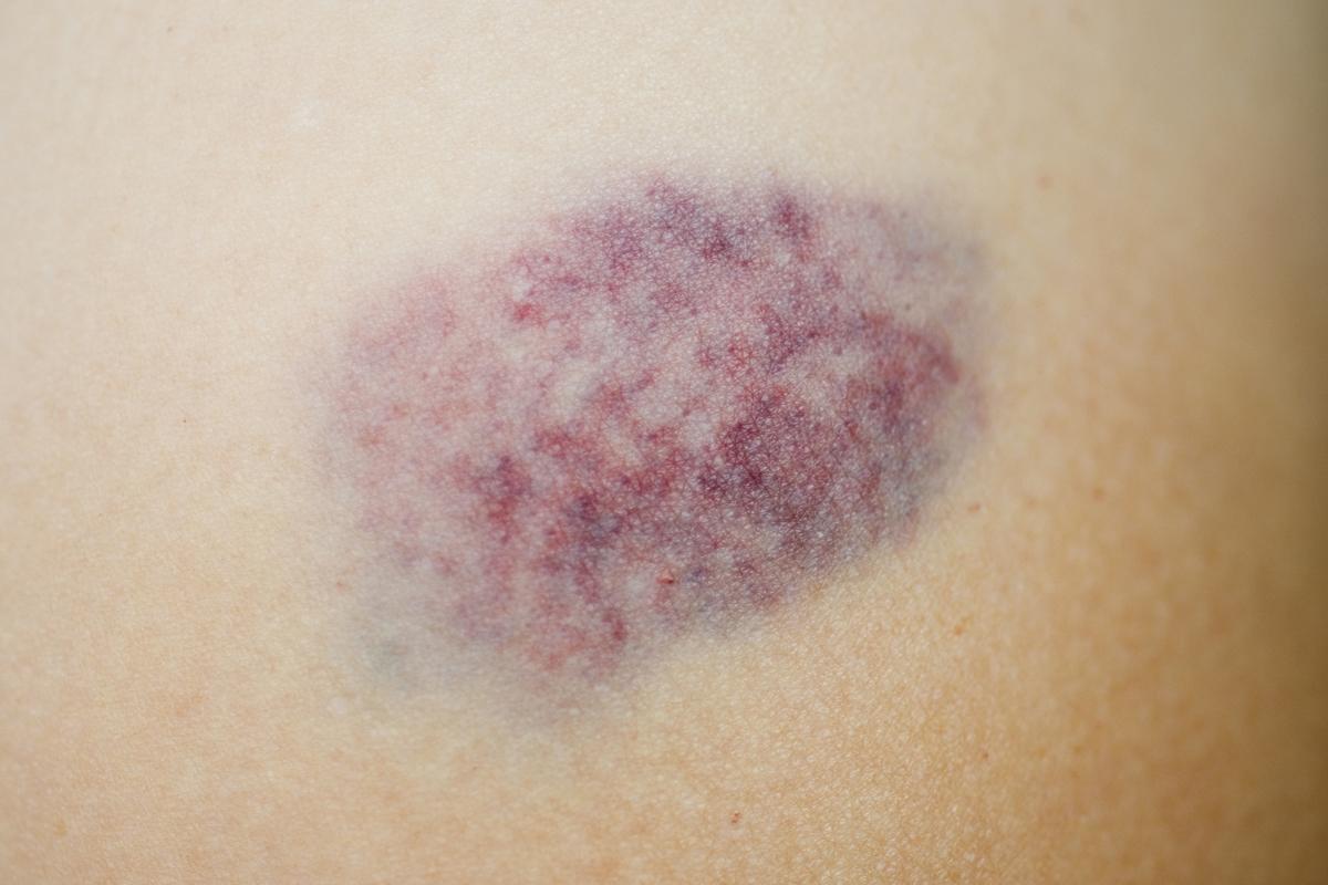 Hematoma (Memar)