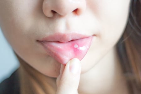 Infeksi HPV Bukan Hanya Mengincar Alat Kelamin, Tapi Juga Mulut