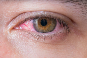 perdarahan subkonjungtiva penyebab mata merah