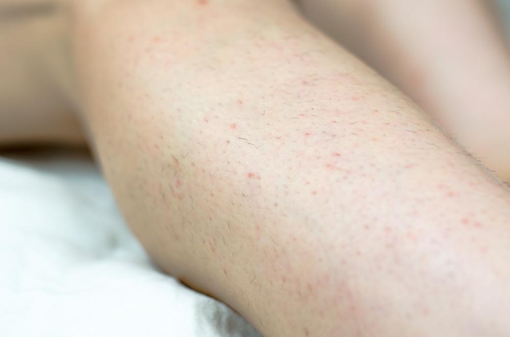 9 Cara Mengatasi Ingrown Hair Rambut Tumbuh ke Dalam