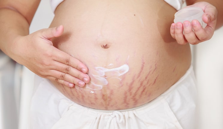 8 Rekomendasi Minyak untuk Stretch Mark Cepat Pudar