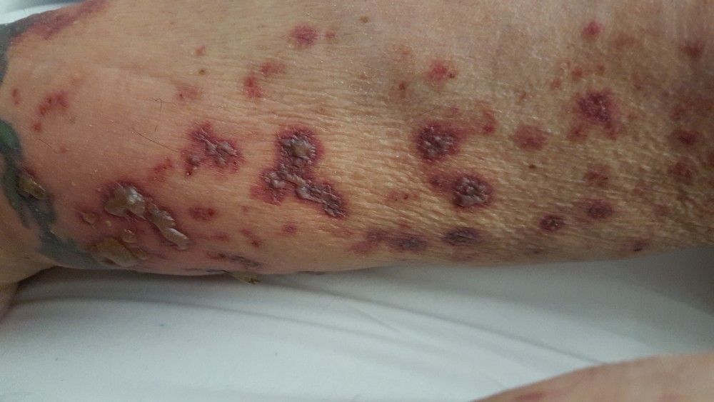 erythema-multiforme