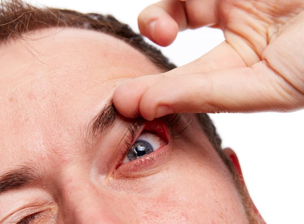 Sindrom Kelopak Mata Terkulai (Floppy Eyelid Syndrome)