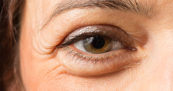 Mewaspadai 7 Jenis Glaukoma yang Mungkin Terjadi
