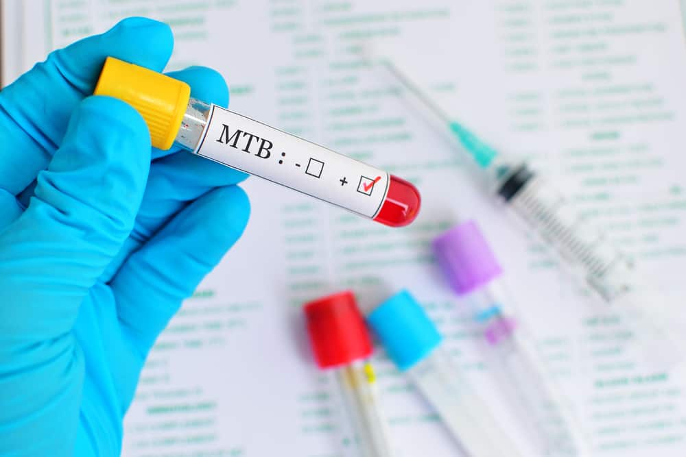 Mengapa Pasien HIV/AIDS (ODHA) Harus Segera Tes TB?