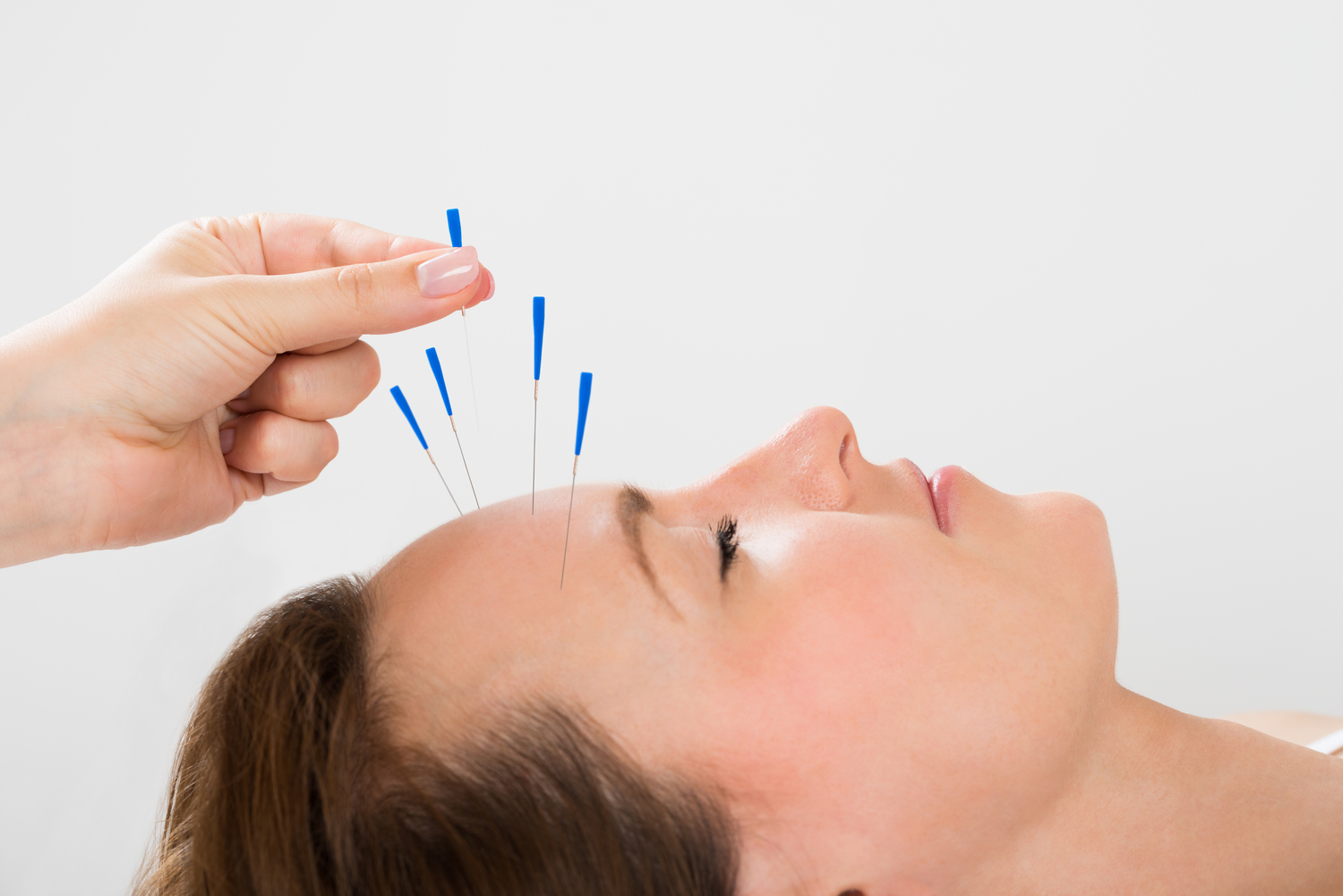 Akupunktur Ternyata Bisa Meredakan Sakit Kepala dan Migrain