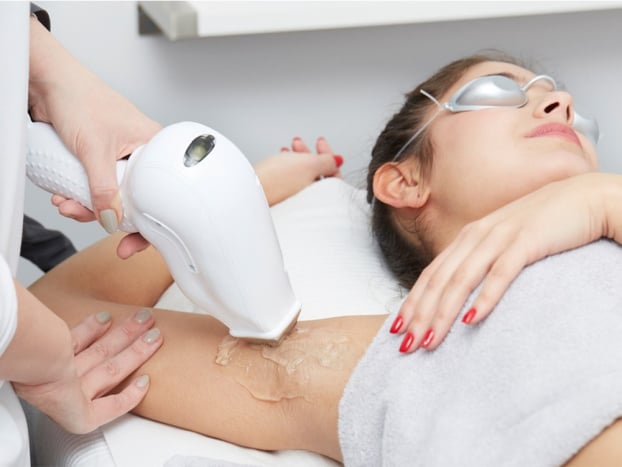 laser hair removal