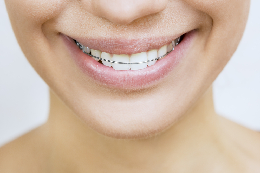 tips-merawat-retainer-gigi
