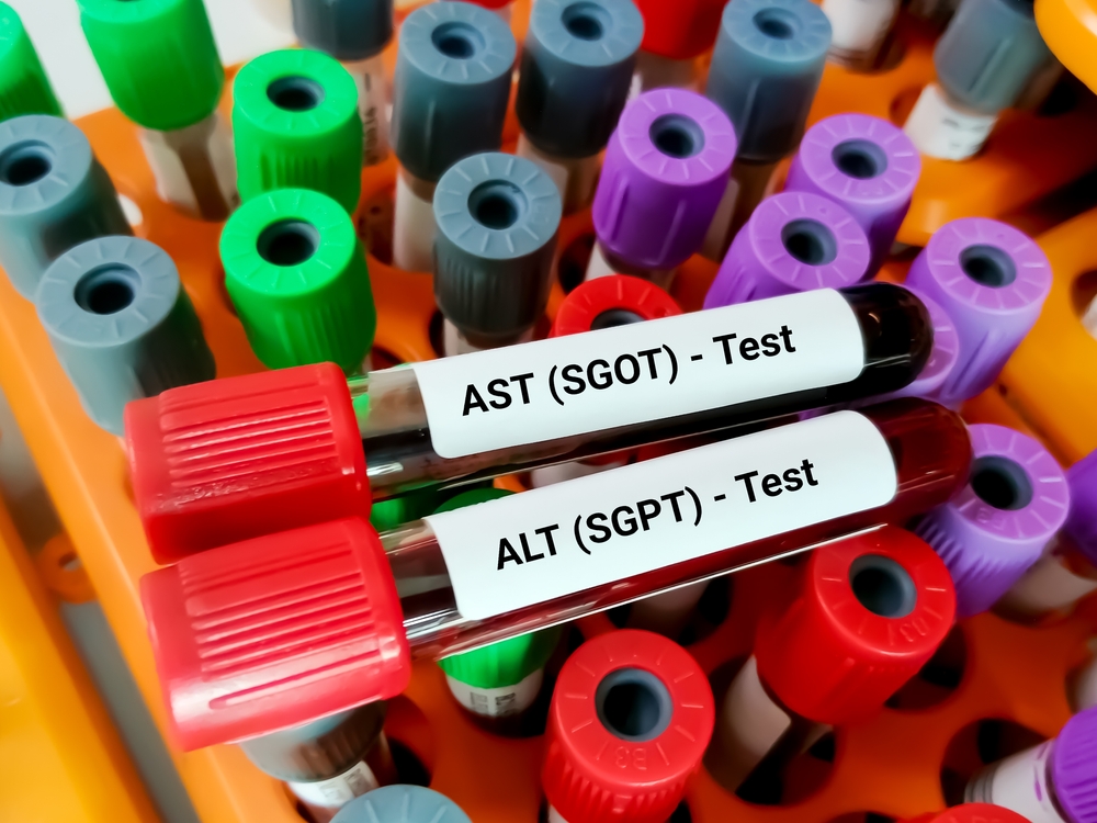 SGOT dan SGPT Tinggi, Pastikah Menandakan Penyakit Hati?