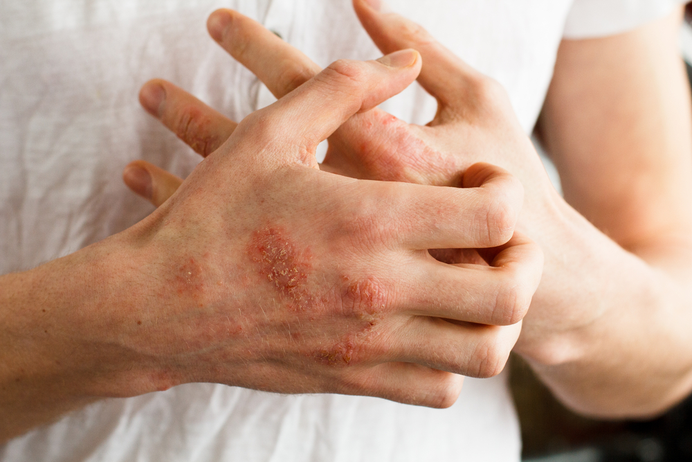 Penyebab Psoriasis dan Faktor Risiko yang Perlu Dihindari