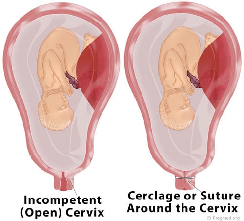 Gambar mulut rahim yang normal
