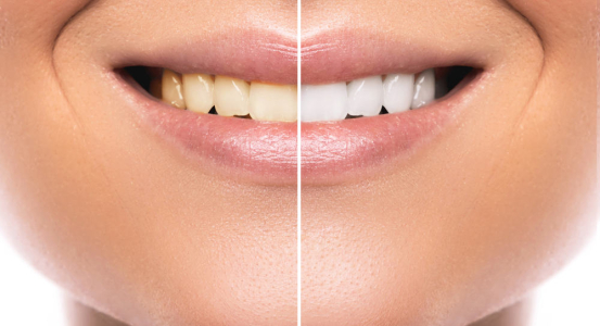 5 Kebiasaan yang Tidak Sadari Membuat Gigi Anda Kuning
