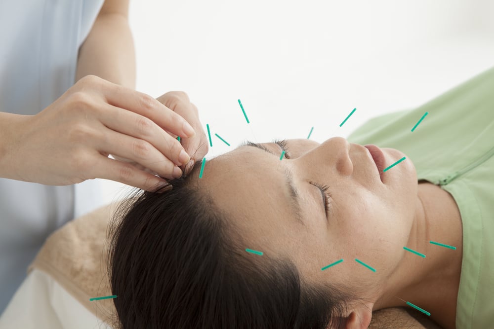manfaat akupunktur wajah