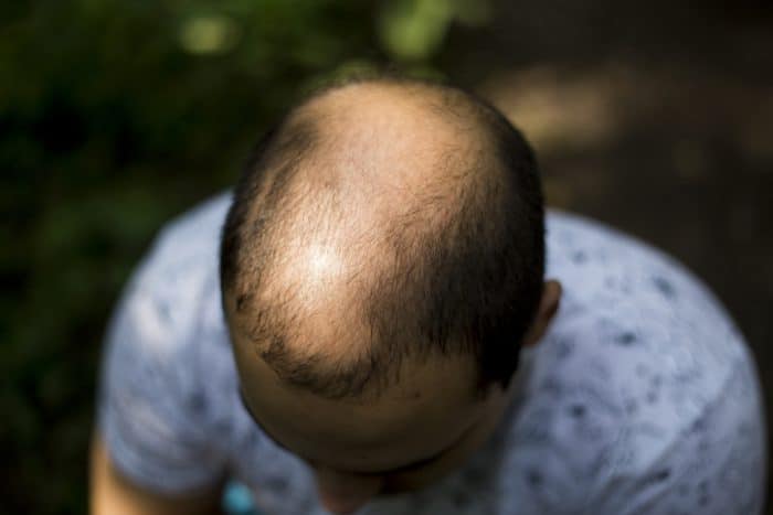 9 Pilihan Pengobatan Alopecia Areata, Kebotakan karena Autoimun