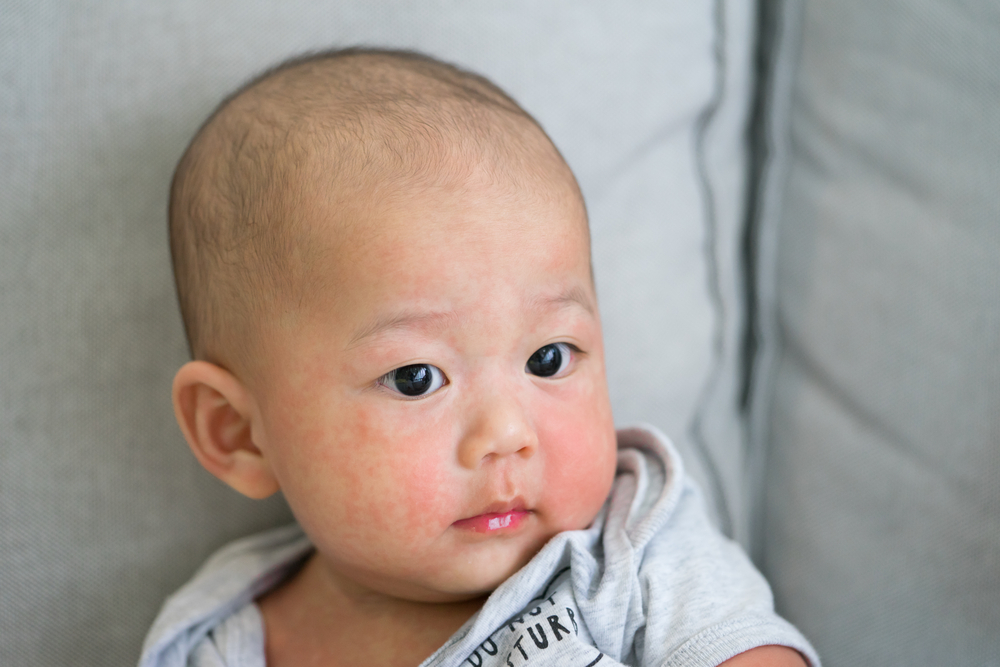 5 Gangguan Kulit yang Paling Umum Terjadi Pada Bayi Prematur