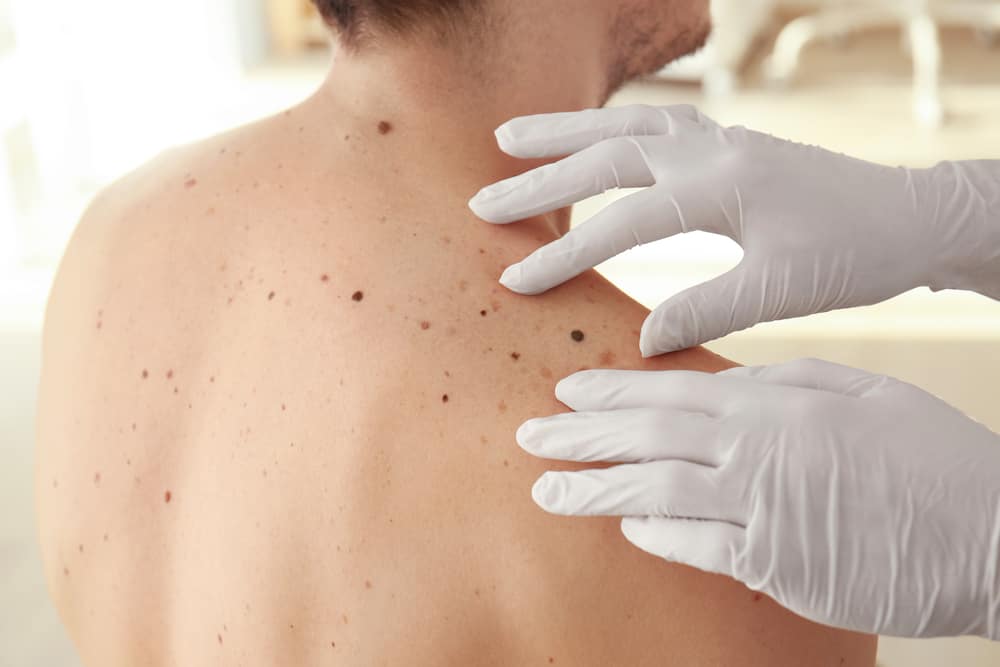 Apakah Penyakit Kanker Kulit Melanoma Menurun dalam Keluarga?