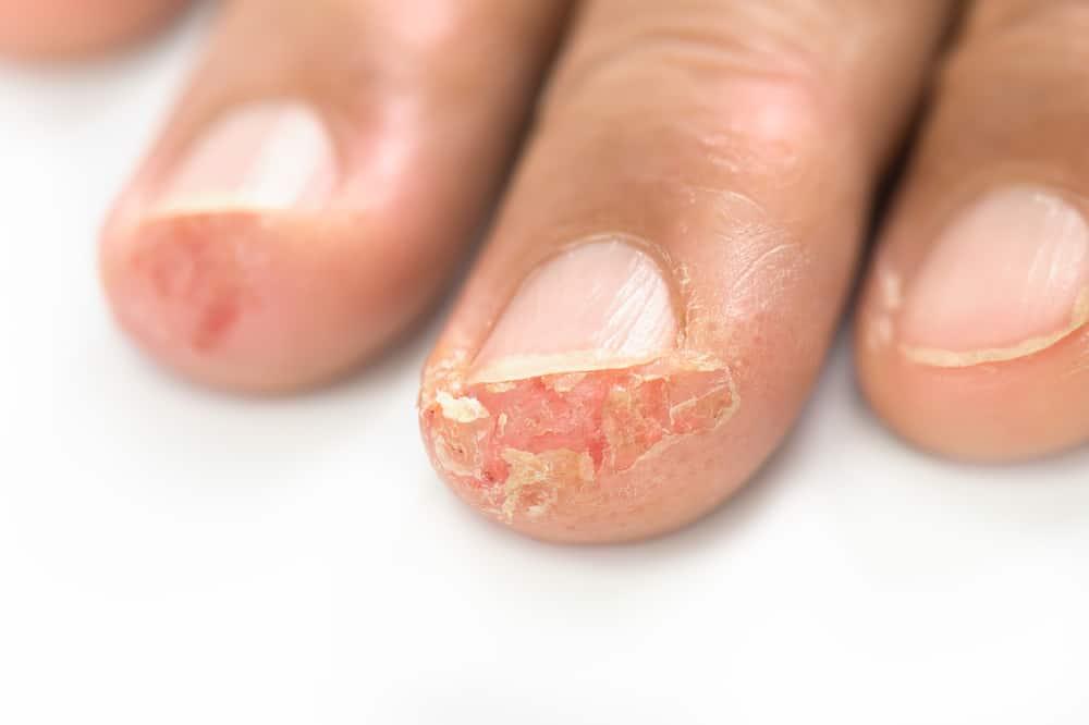 Kulit Jari Mengelupas: Gejala, Penyebab, dan Pengobatan