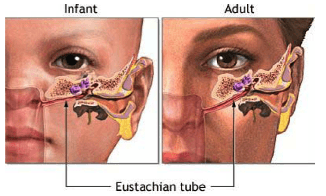 Infeksi Telinga Pada Anak Bisa Disebabkan Pilek yang Lama Sembuhnya