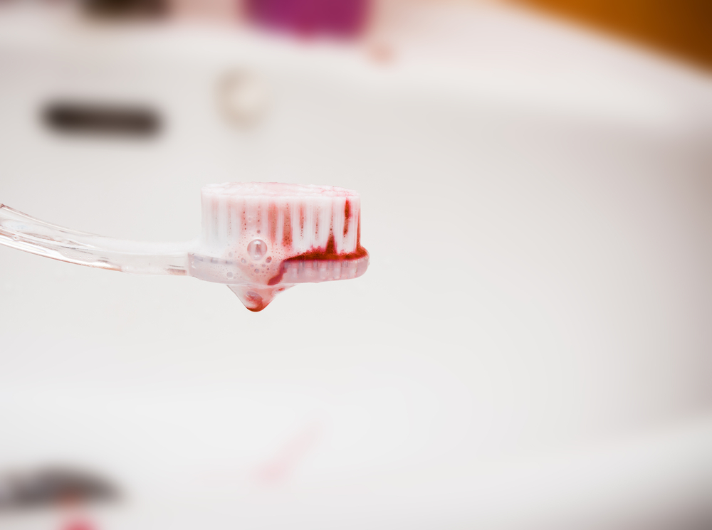 Penyebab Gusi Berdarah saat Sikat Gigi yang Harus Diwaspadai
