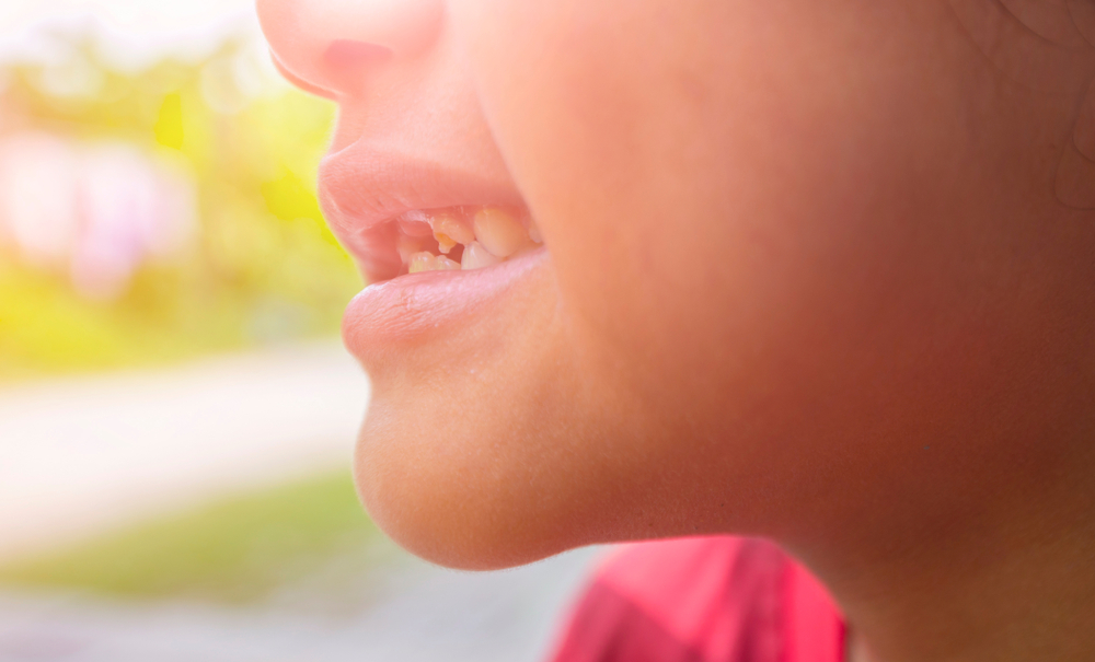 Apakah Gigi Anak Keropos Bisa Tumbuh Kembali?