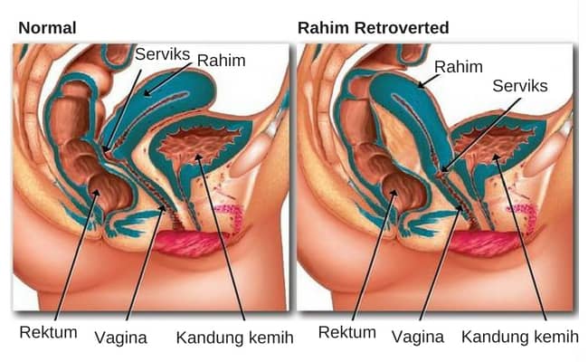 ciri-ciri posisi rahim terbalik