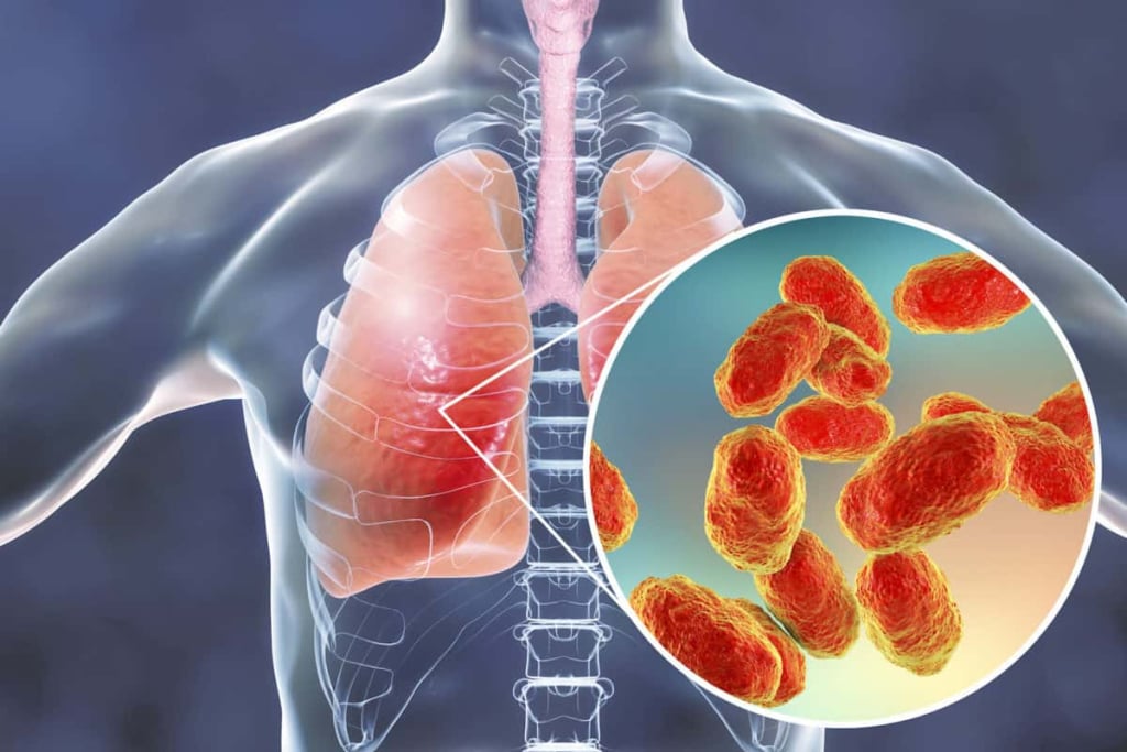 Pneumonia disebabkan bakteri penyebab batuk berdarah