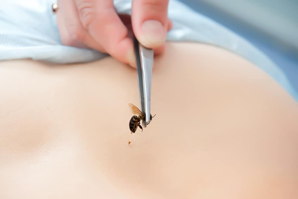 Sembarangan Terapi Sengat Lebah untuk Obati Rematik Bisa Berakibat Fatal