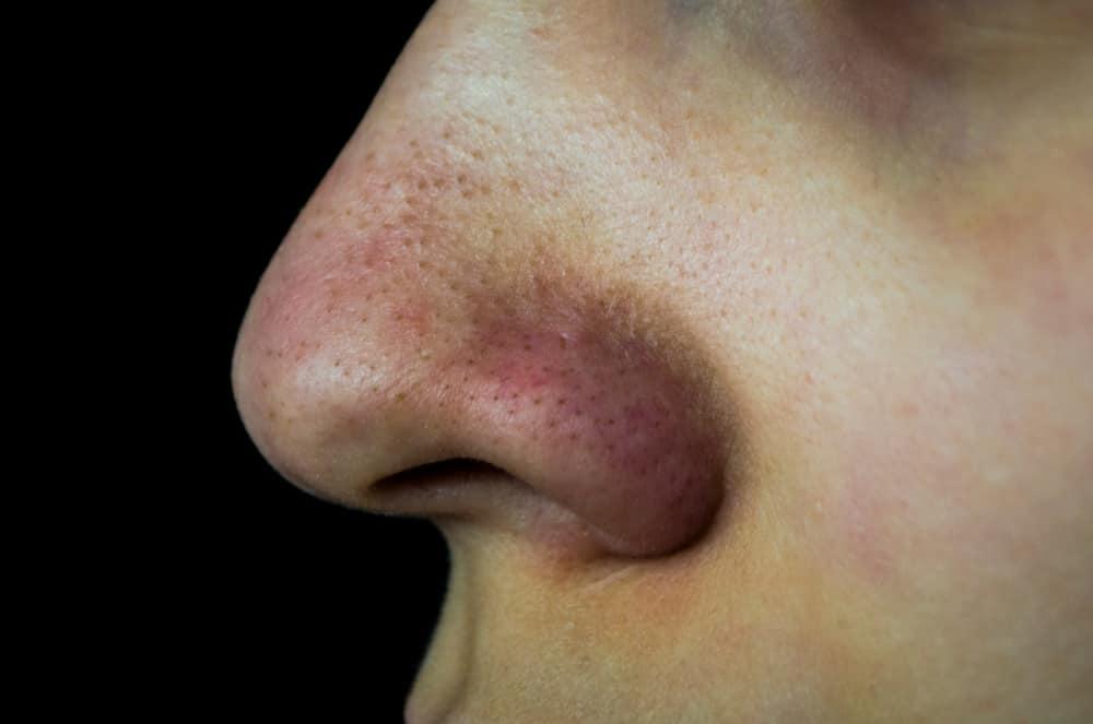 6 Cara Jitu Menghilangkan Jerawat Whitehead (Komedo Putih) di Hidung