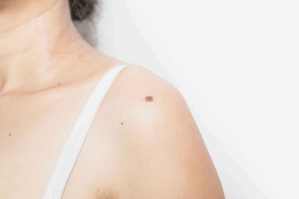 Apa Bedanya Tahi Lalat dan Skin Tag (Acrochordon)?